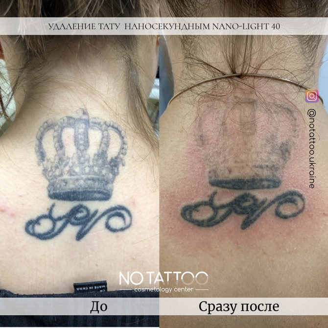 Лазерное удаление тату и татуажа наносекундным и пикосекундным лазерами Київ - зображення 1