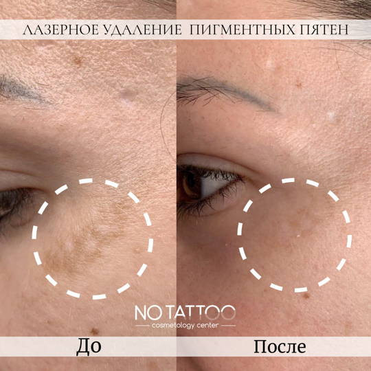 Лазерное удаление пигментных пятен Київ - зображення 1