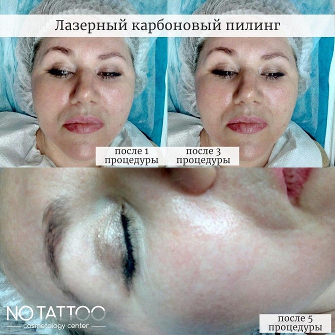 Карбоновый пилинг Киев - изображение 1