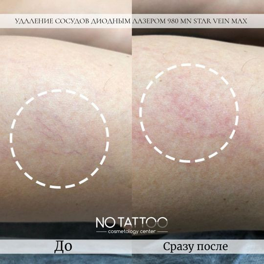 Лазерное удаление сосудов Київ - зображення 1