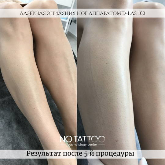 Лазерная эпиляция Киев - изображение 1