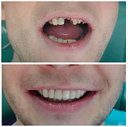 Якісне протезування зубів у місті Черкаси - знижка для пенсіонерів Черкаси
